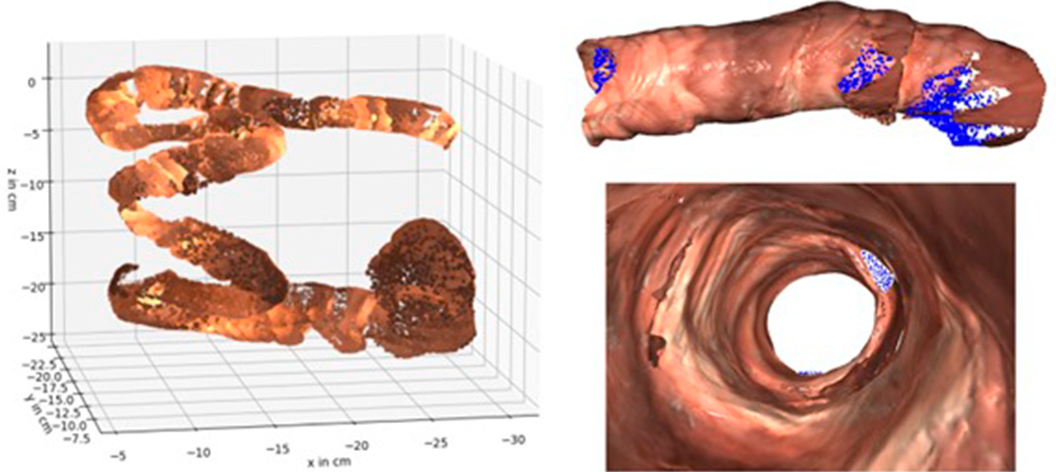 Endo Vision 3D: proyecto para mejorar la detección de cáncer