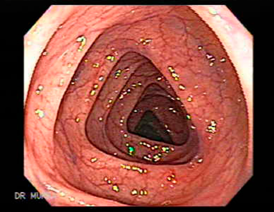 Endo Vision 3D: proyecto para mejorar la detección de cáncer